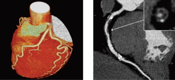 64列コンピューター断層撮影検査（CT）インフォームドコンセントのための心臓・血管病アトラスより一部改変して引用